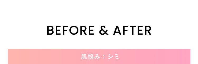 BEFORE&AFTER 肌悩み:シミ